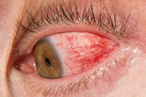 Results of a clinical trial suggest echinacea can help treat autoimmune uveitis.