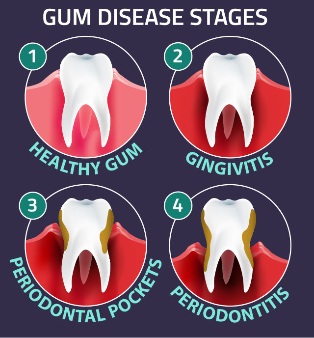 Echinacea Helps Gum Disease Echinacea can help prevent and treat gingivitis.